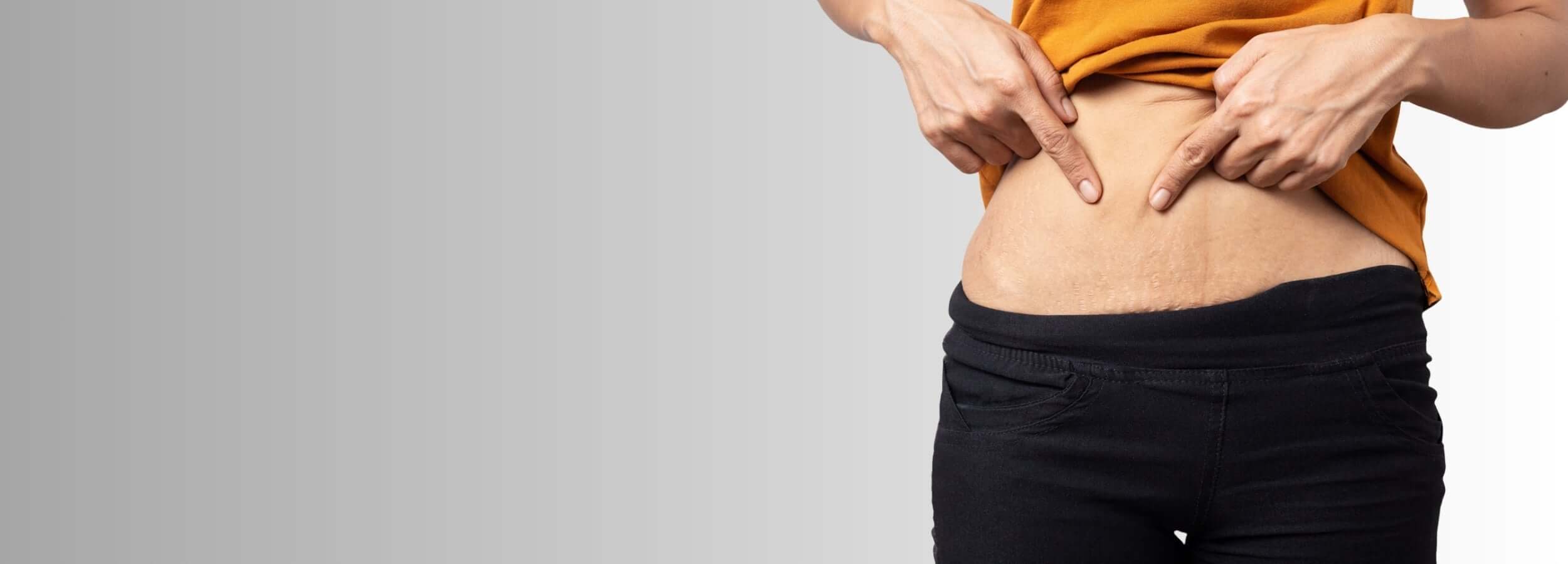 Effective Stretch Mark Treatments in Toronto – close-up of person pointing to stretch marks on lower abdomen before treatment