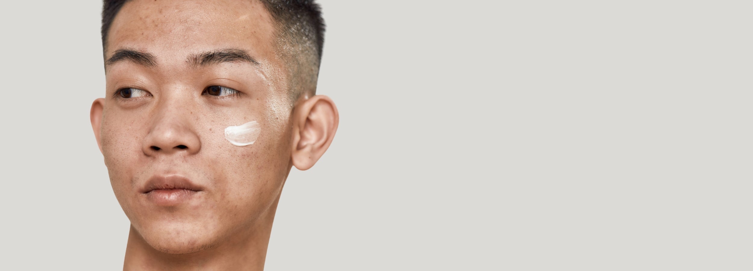 Understanding Hyperpigmentation Laser Treatment Options