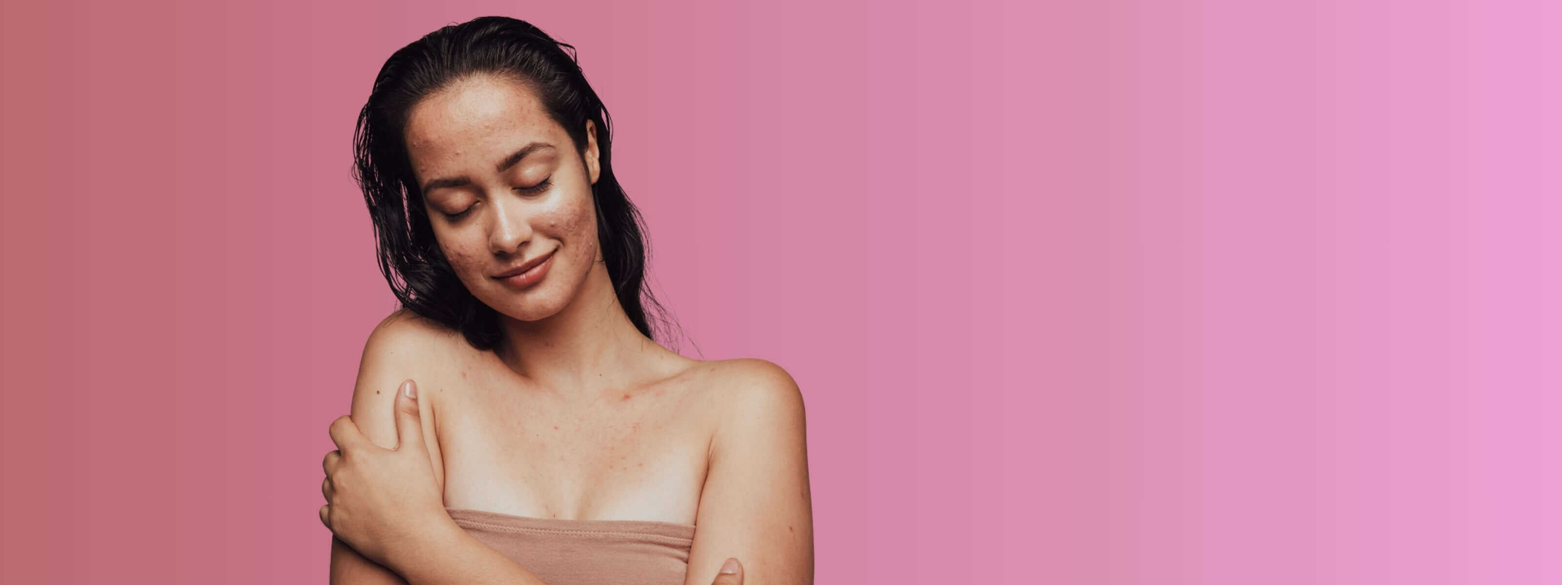 Young woman smiling suffering with acne