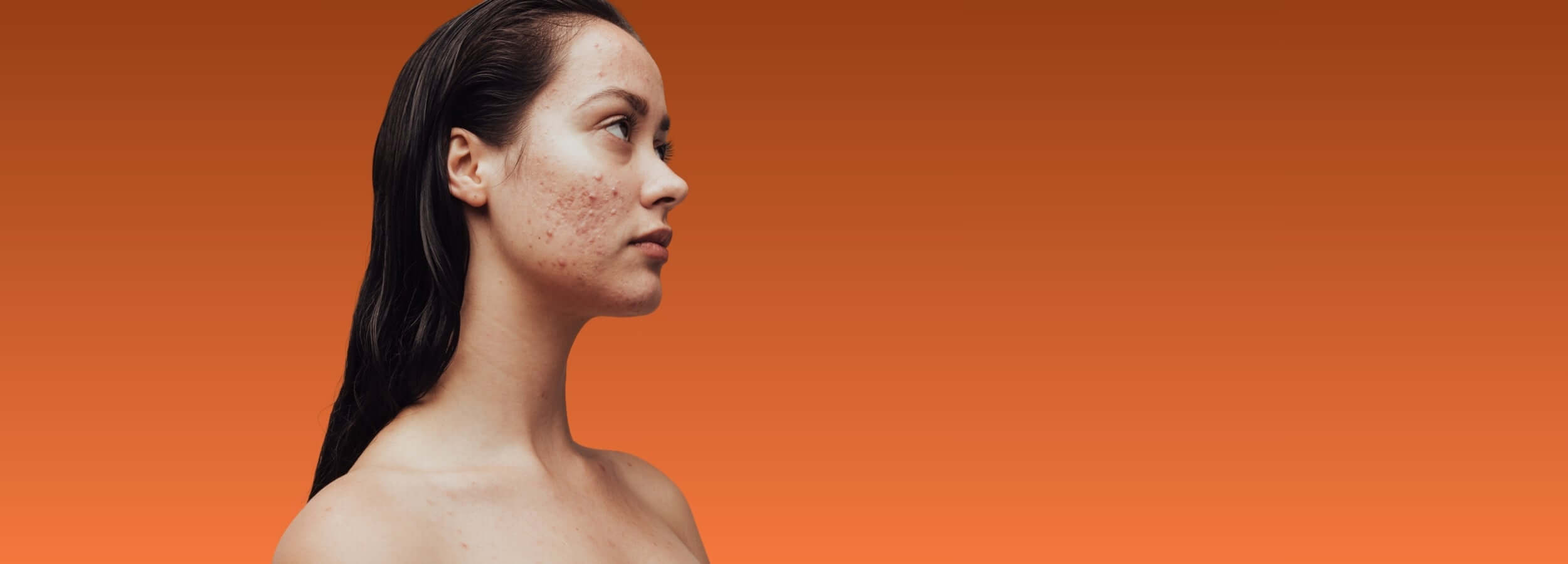 Young woman with acne scarring