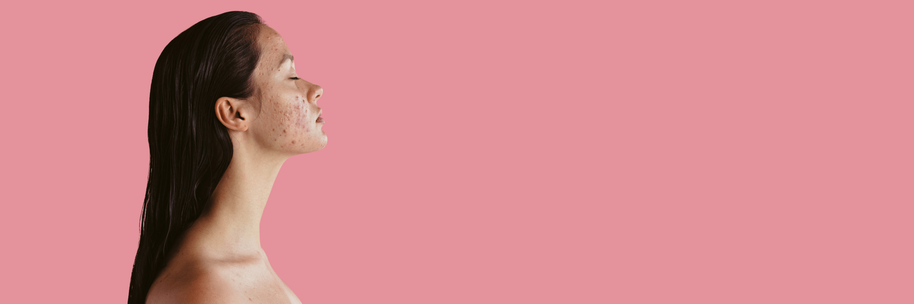Young woman with acne shows face to camera