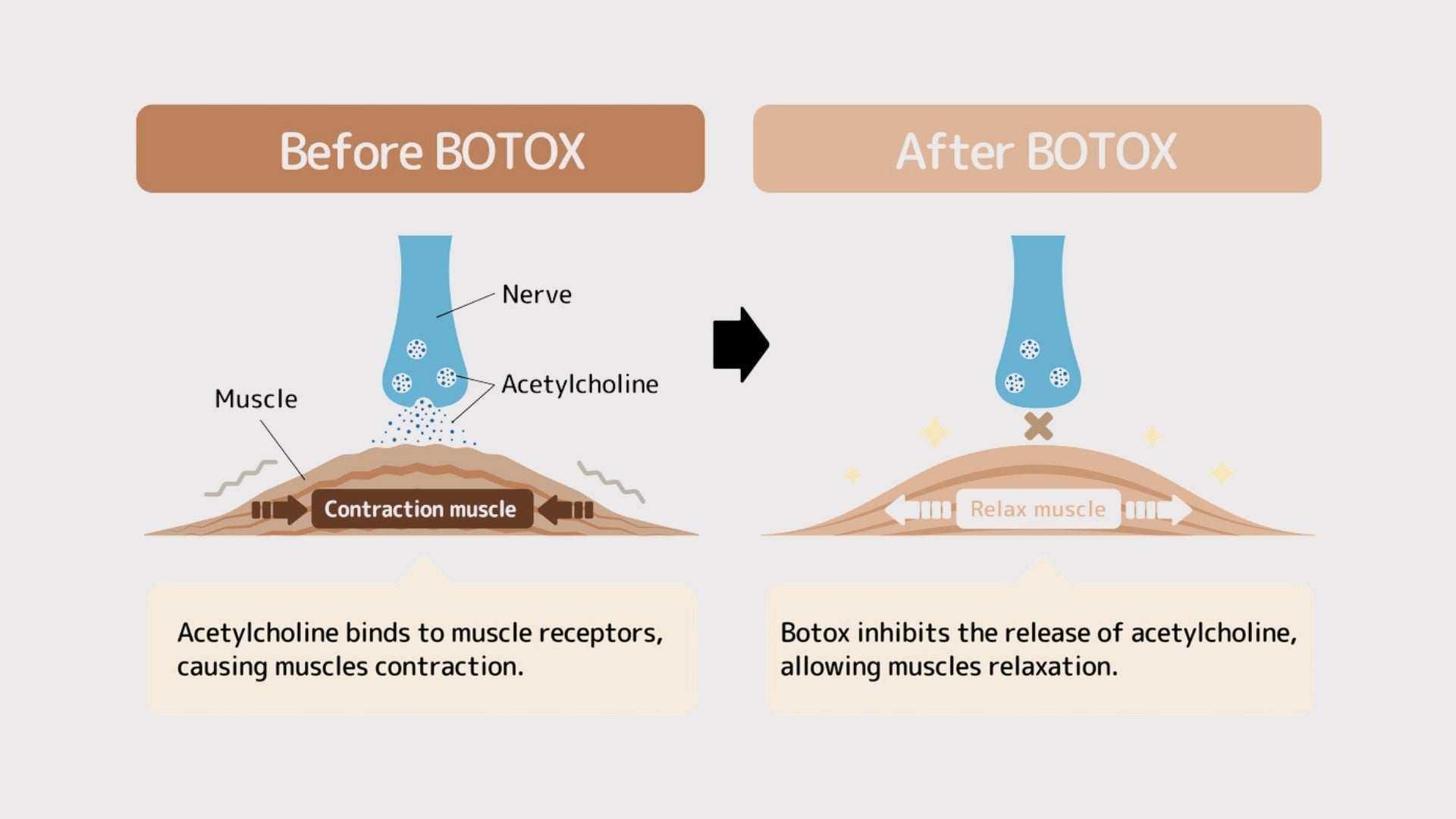 Illustration showing Botox results timeline with before and after effects; before Botox, acetylcholine causes muscle contraction; after Botox, acetylcholine release is inhibited, leading to muscle relaxation.