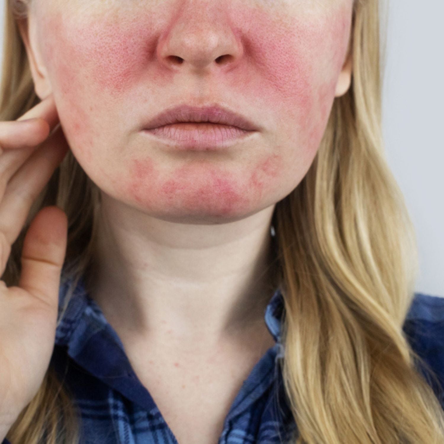 Rosacea