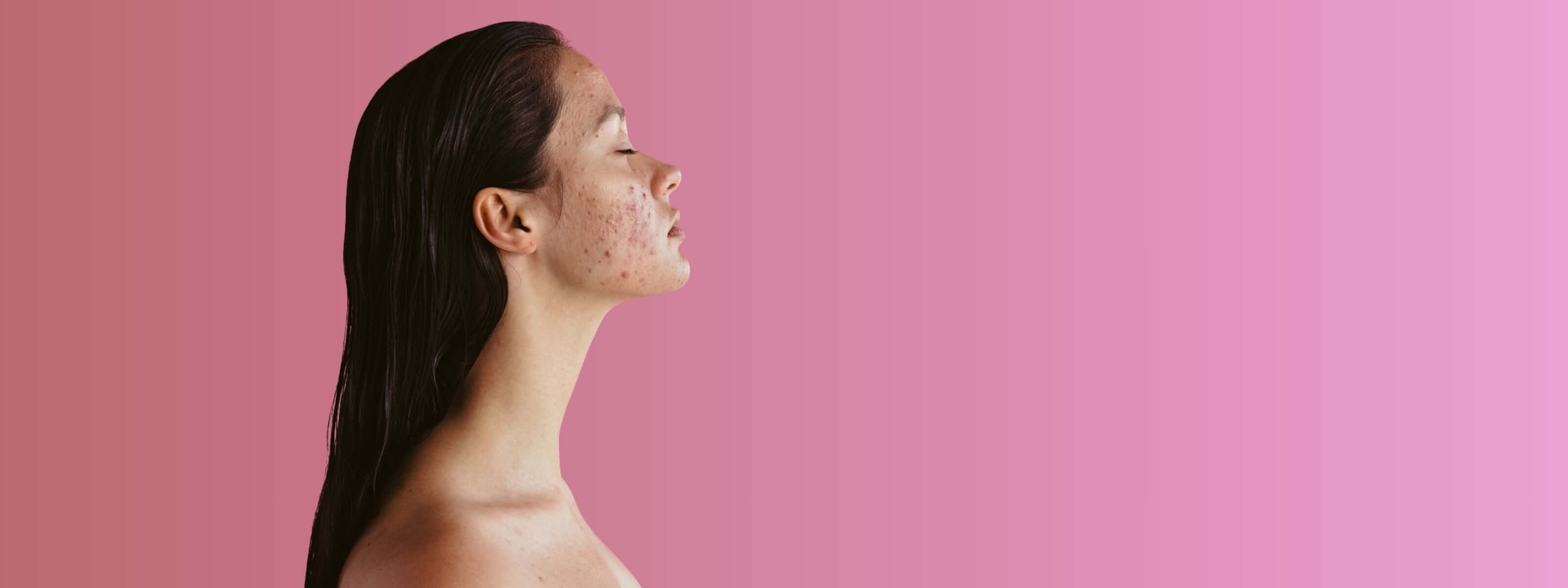 Acne Hero Treatment Page