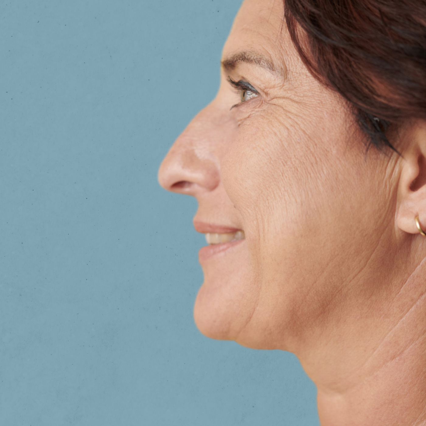 Double Chin Concerns