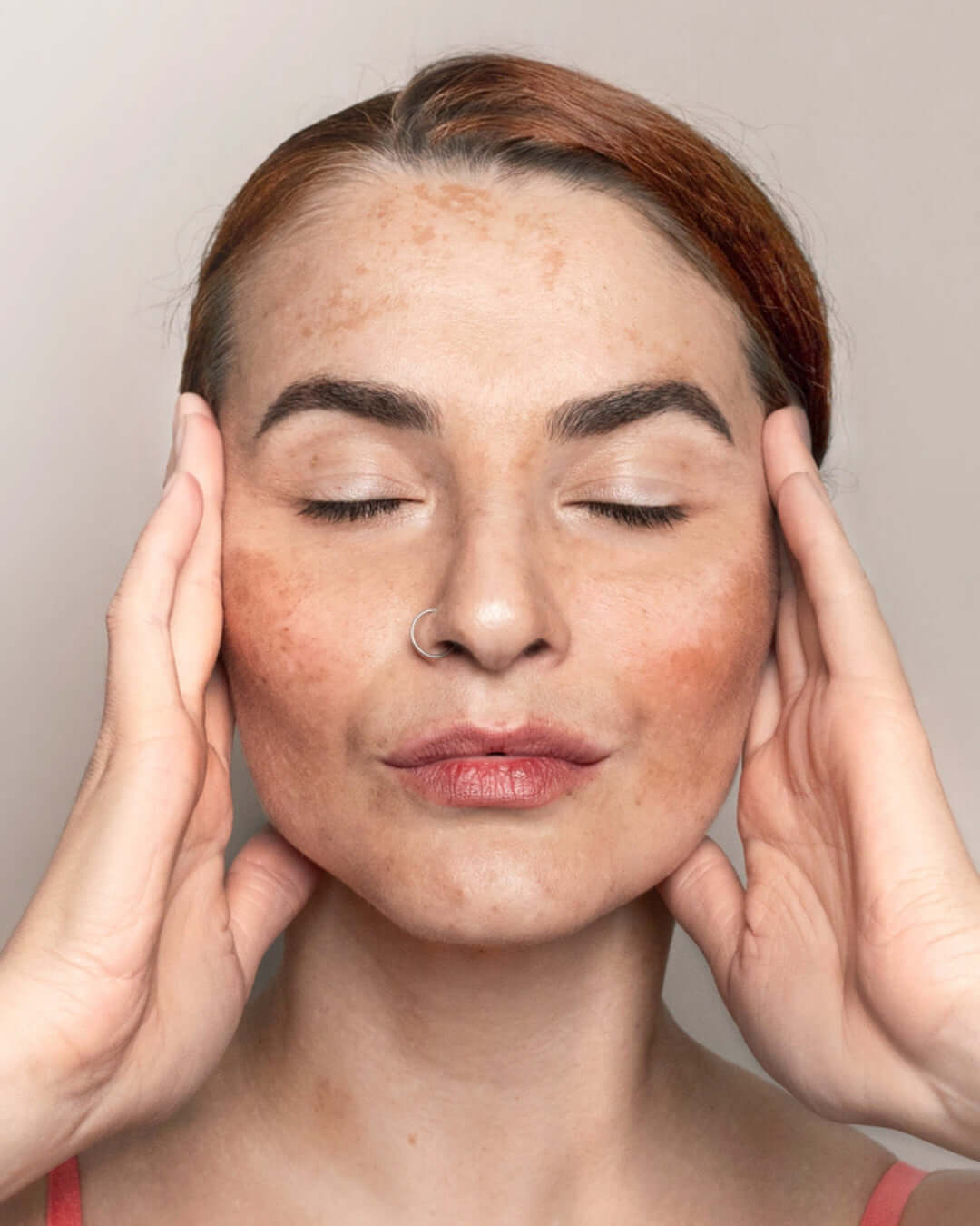 Merrion Melasma Program physician-supervised melasma treatment with laser therapy to fade facial pigmentation and even skin tone