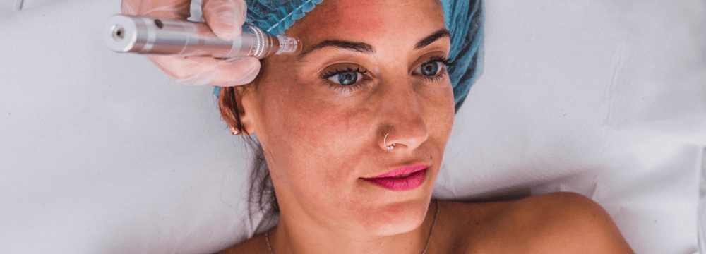 Transform Your Skin: Microneedling Results Explained – microneedling pen treatment on woman’s face to improve texture and fine lines