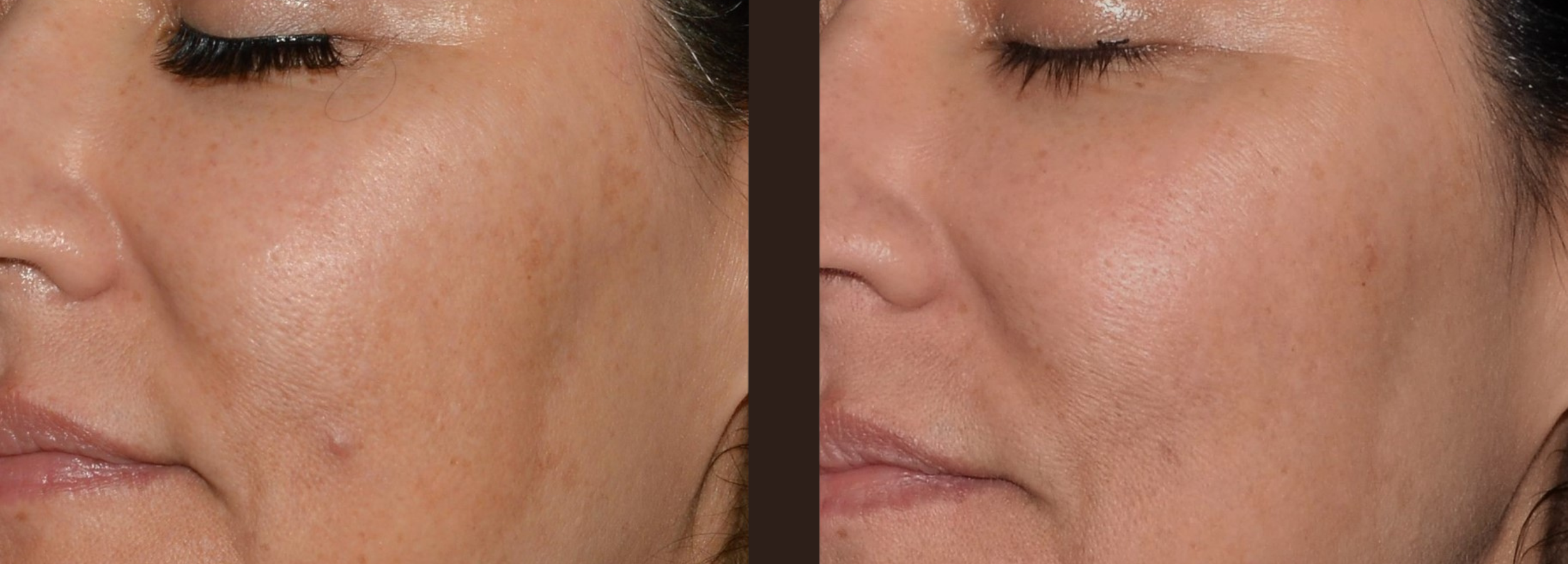 Benefits of Laser Therapy in Skincare