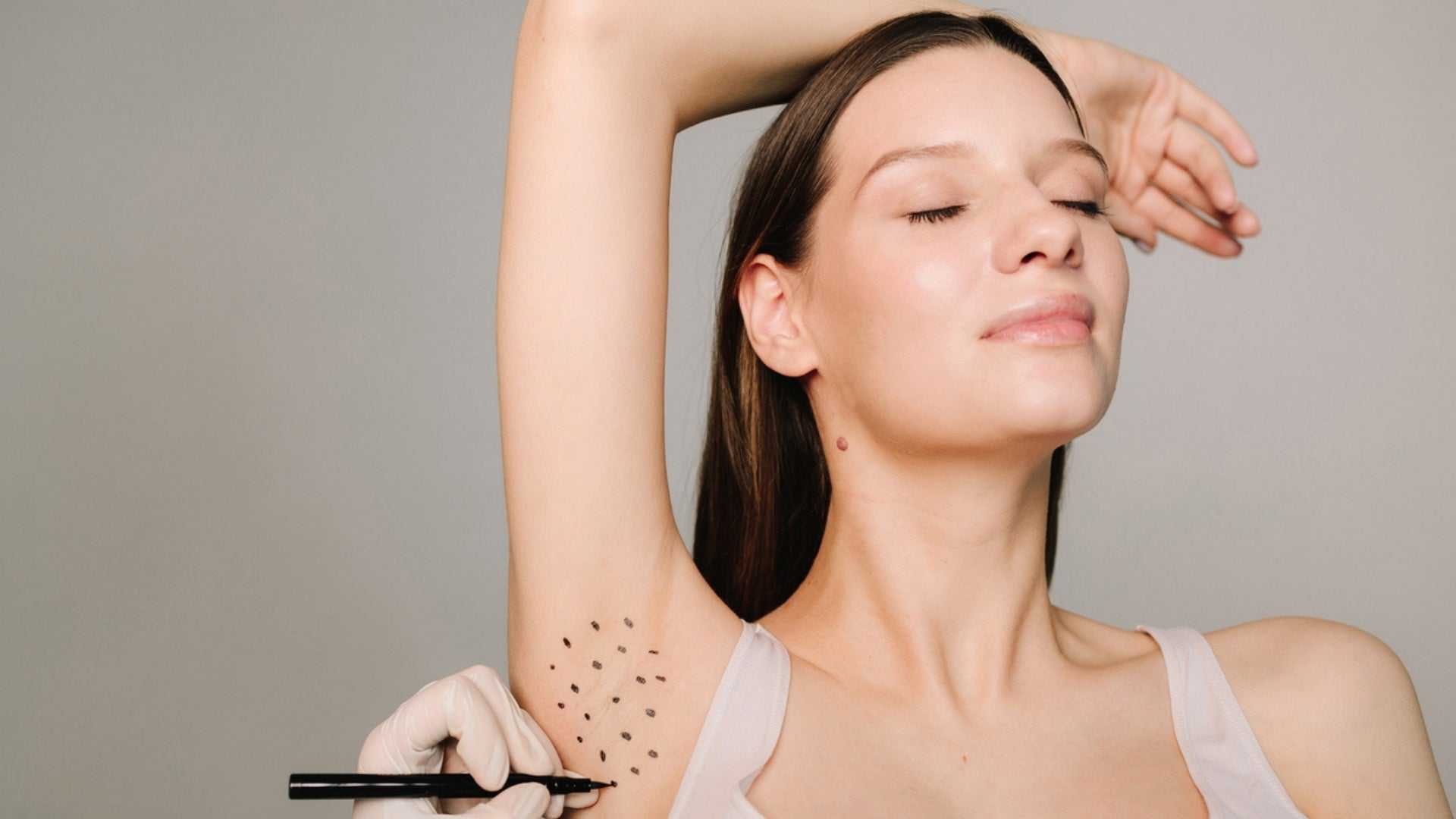 Woman with raised arm showing marked underarm area for botox treatment in Milton clinic