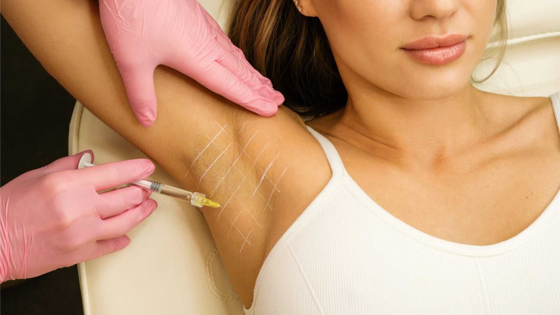 Woman receiving Botox injection in armpit to treat excessive sweating (hyperhidrosis).