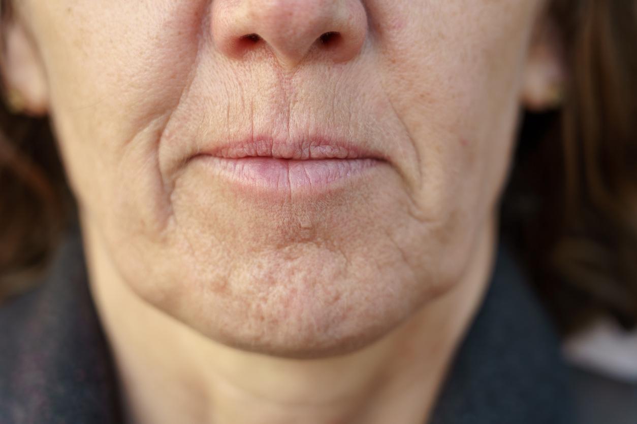 Uneven Texture close-up of lower face showing rough skin texture and visible pores for resurfacing and smoothing skincare