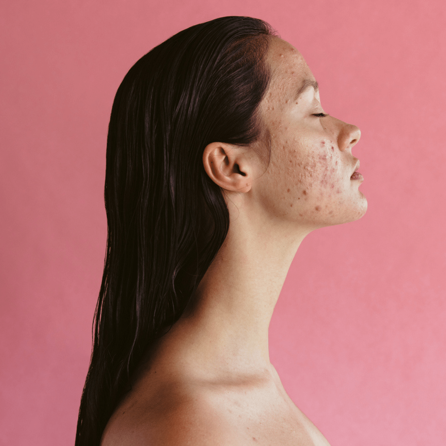 Acne-prone skin.