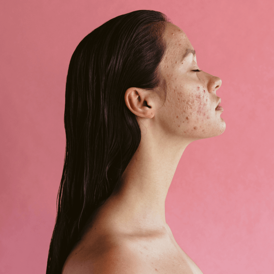 Acne treatment protocol model with visible breakouts and post-acne marks on cheek, side profile on pink background