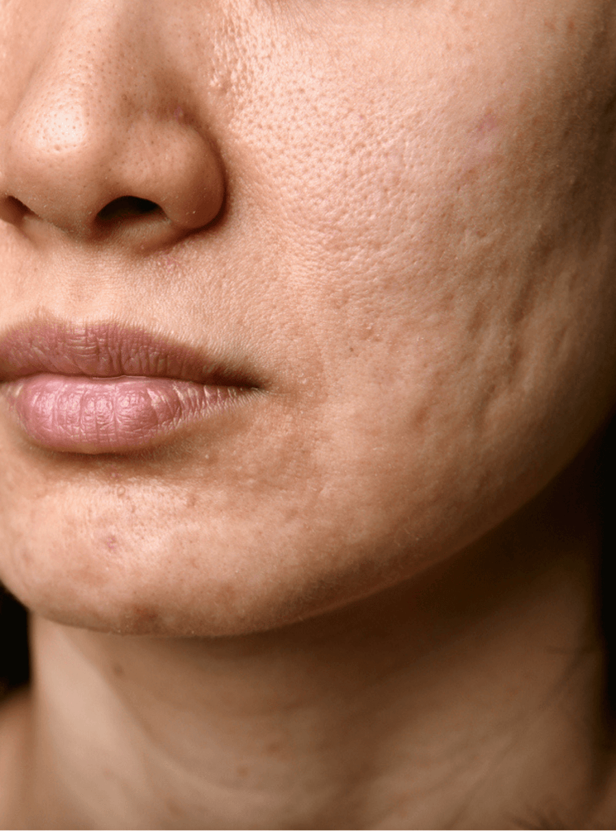 Scarring on cheek and jawline with uneven skin texture and visible acne scar marks, close-up skin resurfacing concern