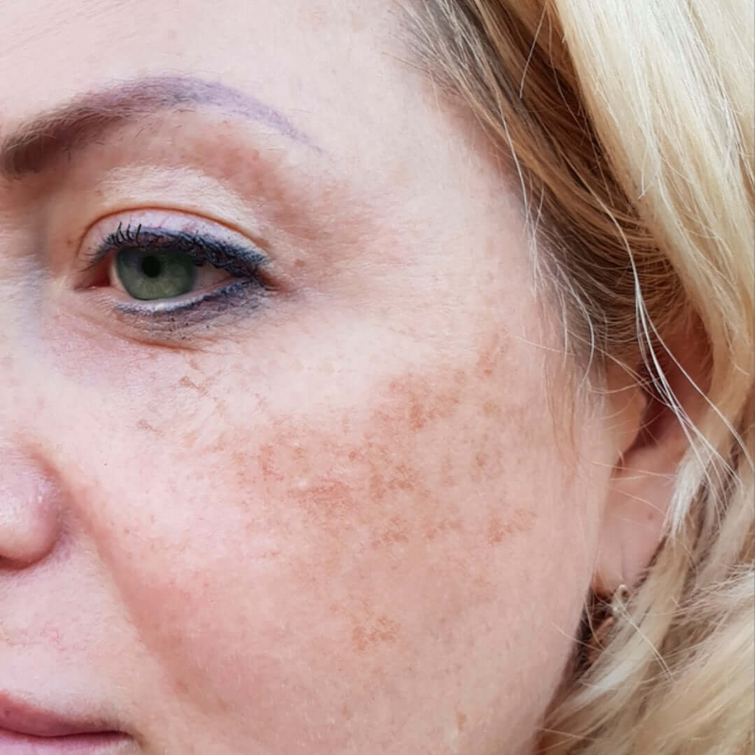 Pigmentation close-up of facial hyperpigmentation and uneven skin tone on cheek, showing dark spots and sun damage
