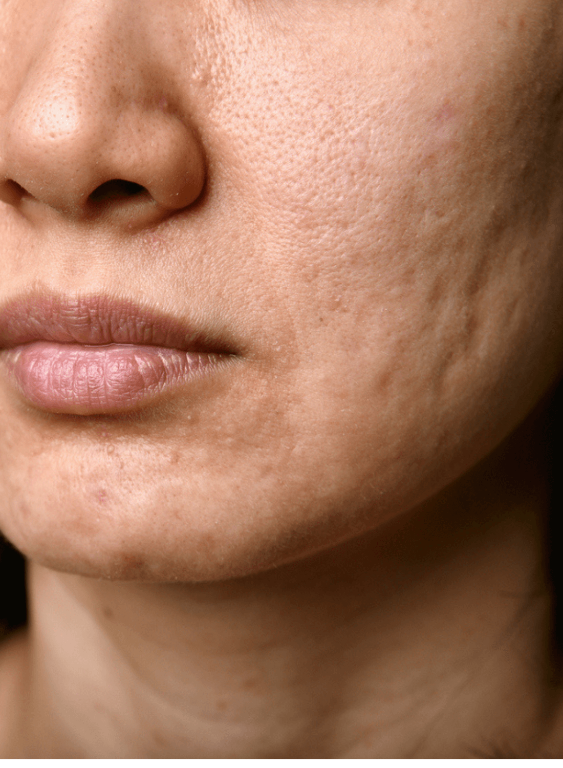 Melasma hyperpigmentation patches on cheek and upper lip, close-up facial skin texture