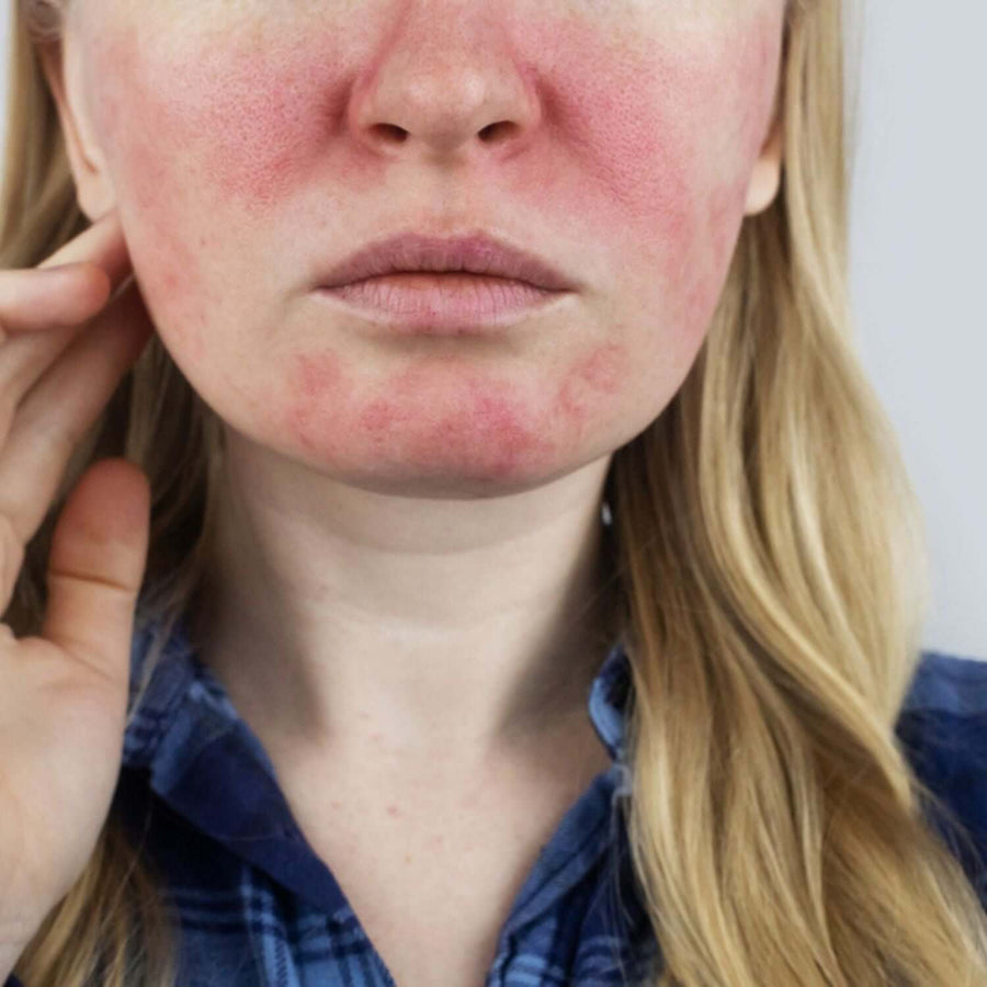 Rosacea facial redness and flushing with inflamed cheeks and chin, visible irritation close-up