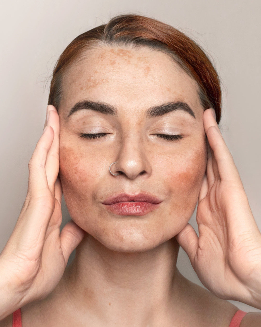 Woman with hands on temples against a neutral background. Melasma treatment program for hormonal pigmentation - six-session clinical laser therapy with specialized ampoules at Merrion Medical Aesthetics Oakville
