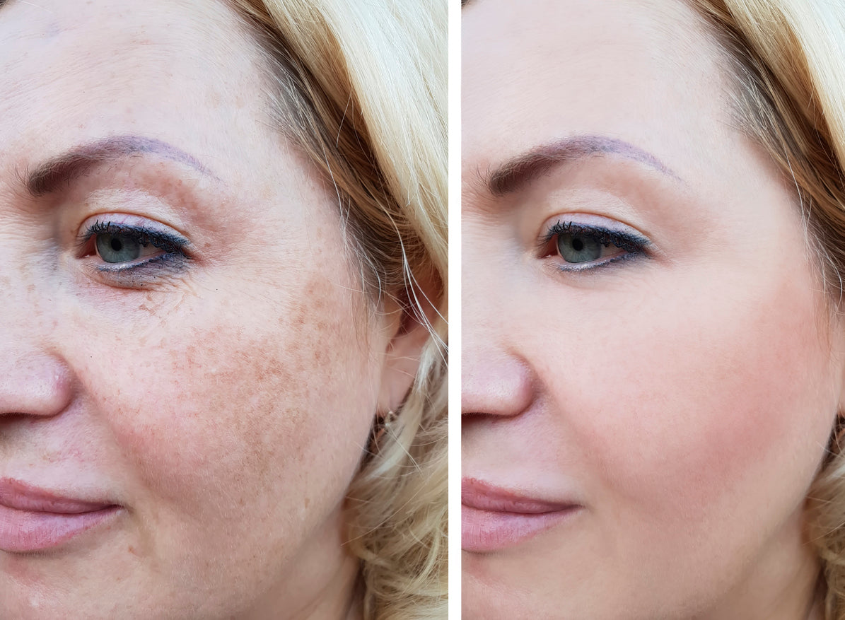 Before and after comparison of a woman's face with visible skin texture changes.