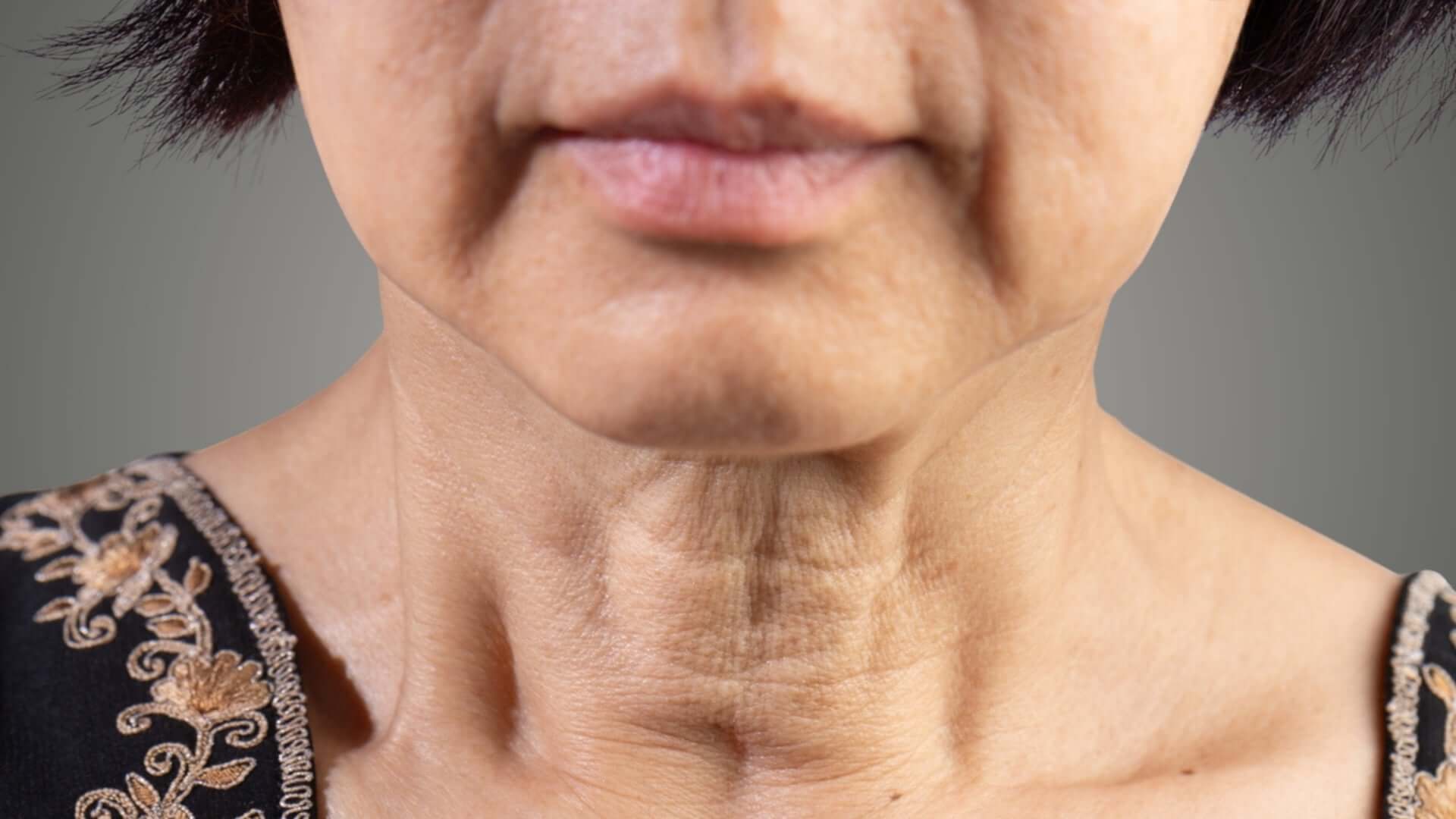 Facial Sagging Laxity