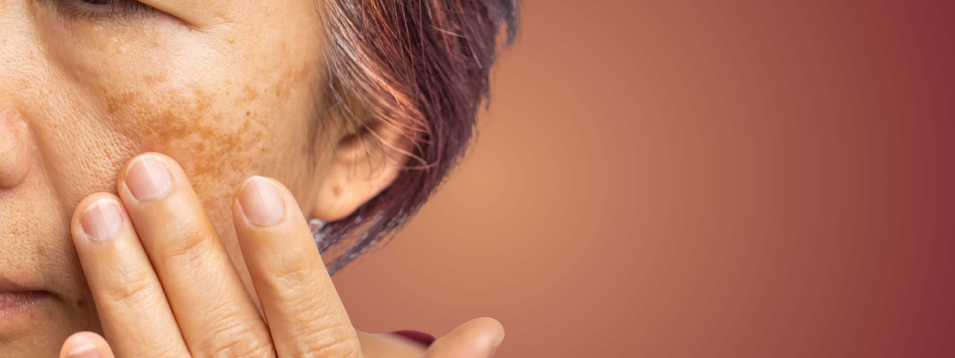 Pigmentation Hero Treatment