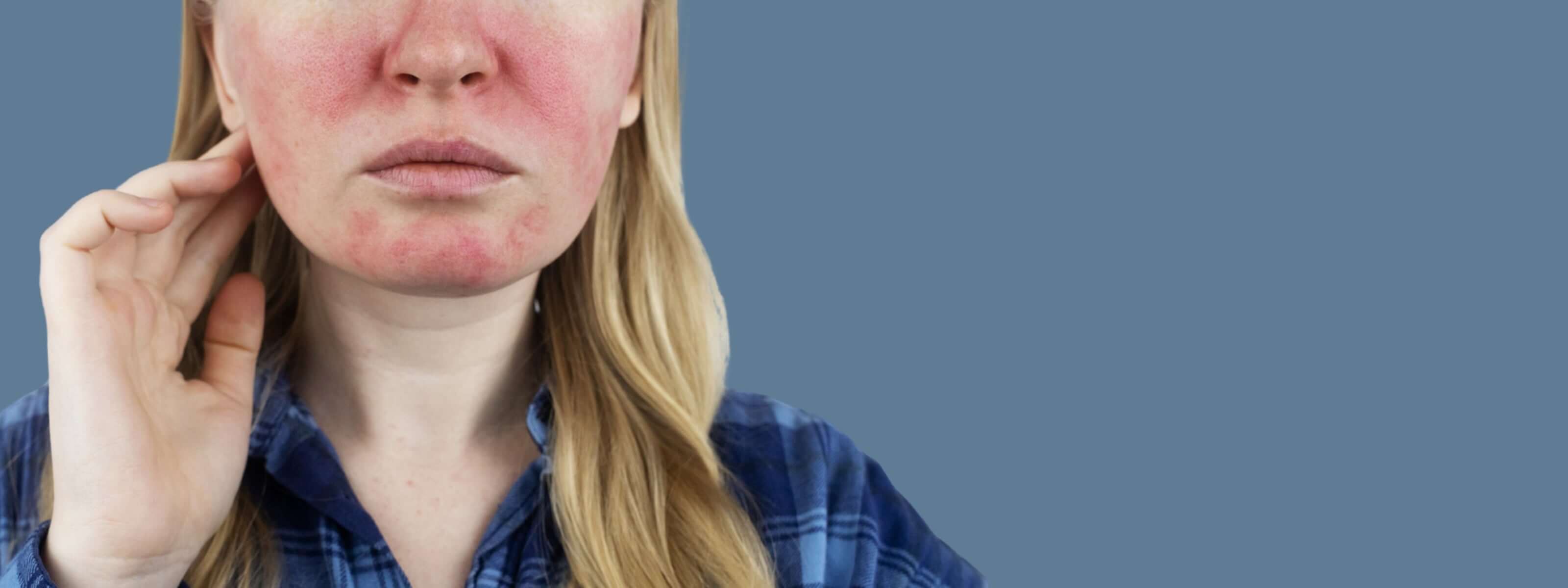 Rosacea 3200 1200