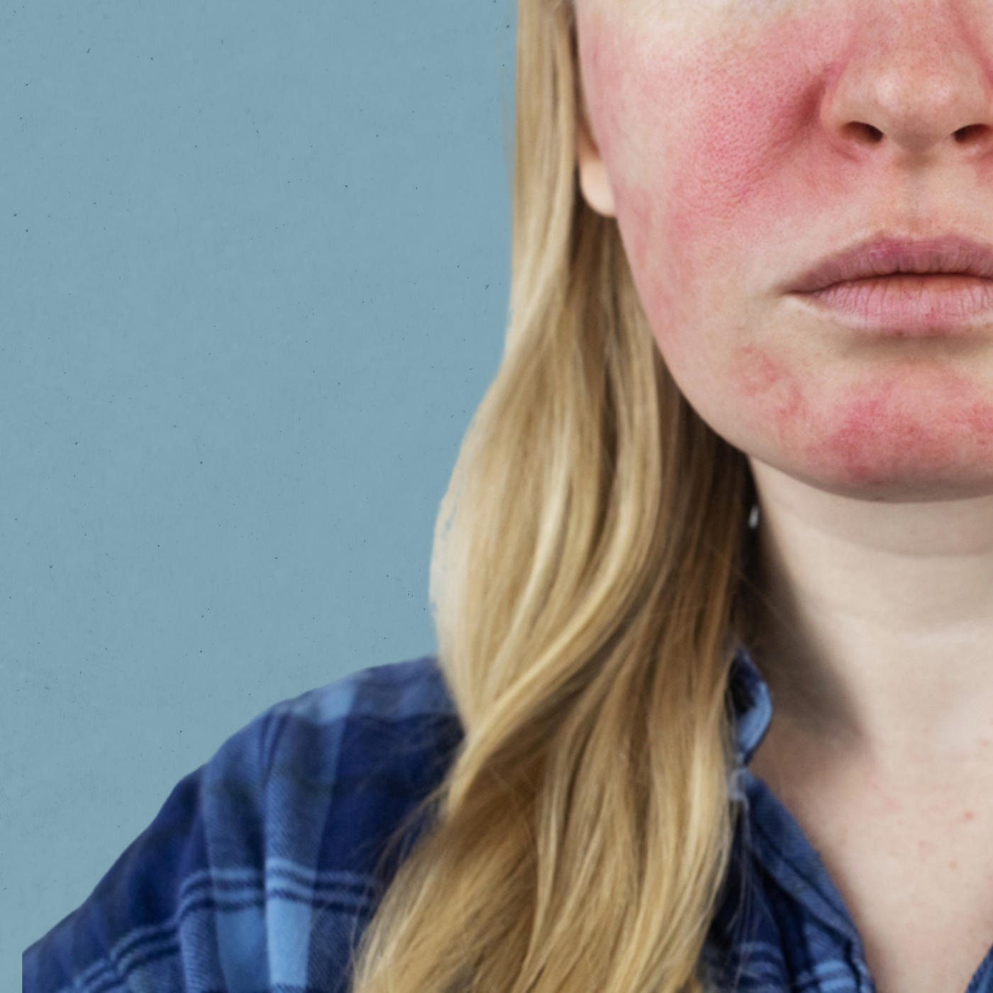 Rosacea Concerns