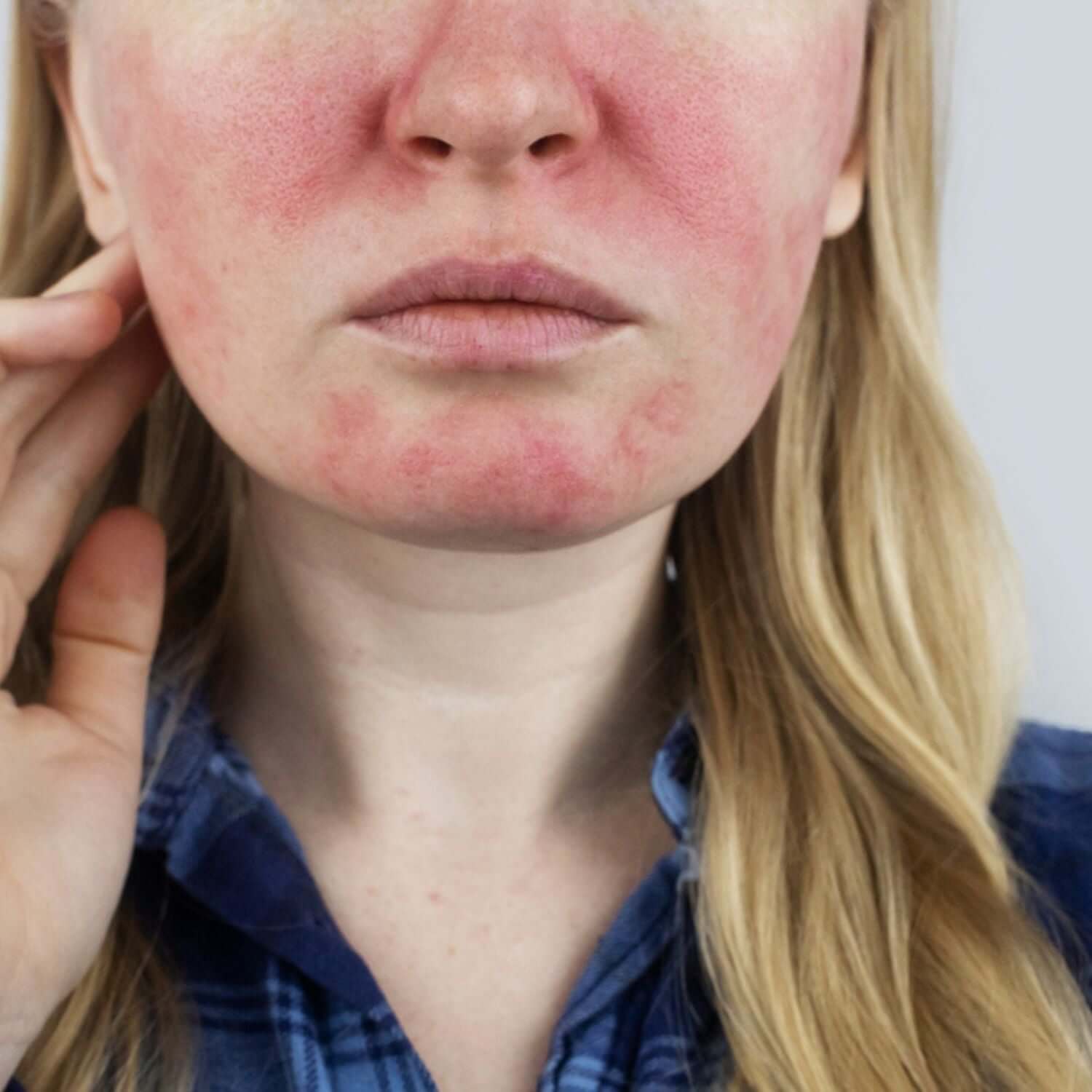Rosacea Face